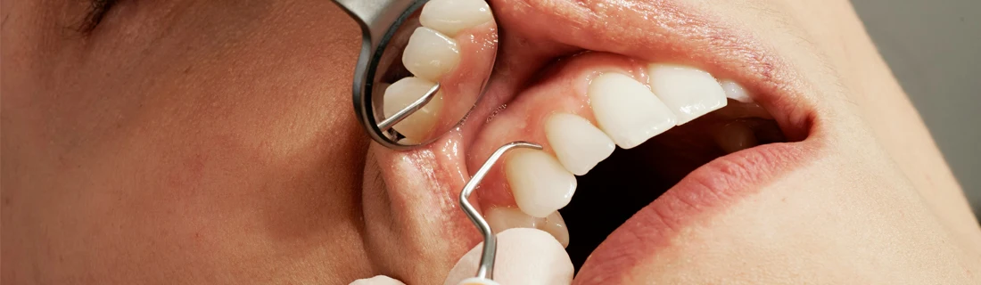 an extreme close up detailing a person's mouth and gums getting scraped at the dentist